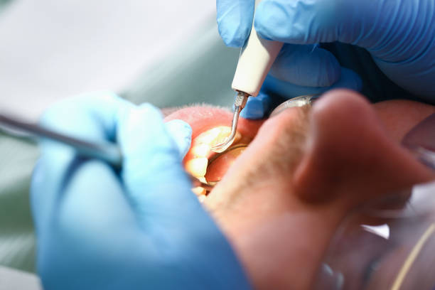 Best Emergency Dentist for Lost Fillings or Crowns in Fairfield, OH